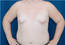 Breast Lift Before Photo by Ricardo Rodriguez, MD; Lutherville-Timonium, MD - Case 27019