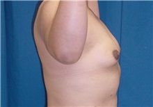 Breast Lift Before Photo by Ricardo Rodriguez, MD; Lutherville-Timonium, MD - Case 27020