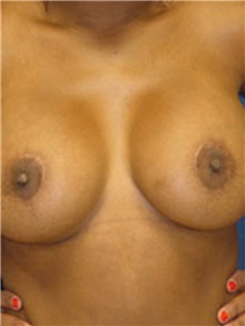 Breast Lift After Photo by Ricardo Rodriguez, MD; Lutherville-Timonium, MD - Case 27021