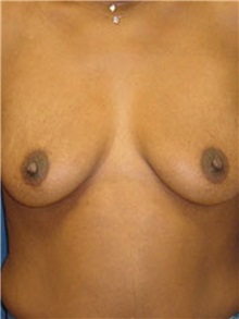 Breast Lift Before Photo by Ricardo Rodriguez, MD; Lutherville-Timonium, MD - Case 27021
