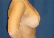 Breast Lift After Photo by Ricardo Rodriguez, MD; Lutherville-Timonium, MD - Case 27024