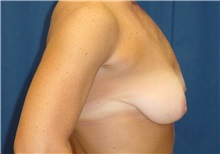 Breast Lift Before Photo by Ricardo Rodriguez, MD; Lutherville-Timonium, MD - Case 27024