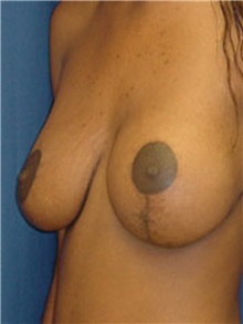 Breast Lift Before Photo by Ricardo Rodriguez, MD; Lutherville-Timonium, MD - Case 27026
