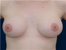 Breast Lift After Photo by Ricardo Rodriguez, MD; Lutherville-Timonium, MD - Case 27027