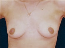 Breast Lift Before Photo by Ricardo Rodriguez, MD; Lutherville-Timonium, MD - Case 27027