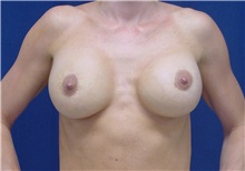 Breast Lift After Photo by Ricardo Rodriguez, MD; Lutherville-Timonium, MD - Case 27028
