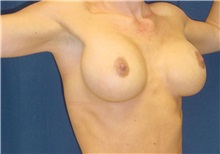 Breast Lift After Photo by Ricardo Rodriguez, MD; Lutherville-Timonium, MD - Case 27028