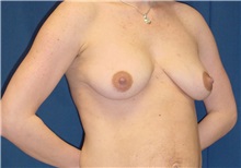 Breast Lift Before Photo by Ricardo Rodriguez, MD; Lutherville-Timonium, MD - Case 27028