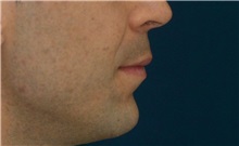 Dermal Fillers Before Photo by Ricardo Rodriguez, MD; Lutherville-Timonium, MD - Case 27031