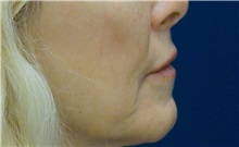 Dermal Fillers After Photo by Ricardo Rodriguez, MD; Lutherville-Timonium, MD - Case 27032
