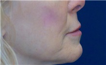 Dermal Fillers Before Photo by Ricardo Rodriguez, MD; Lutherville-Timonium, MD - Case 27032
