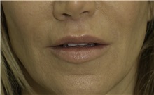 Dermal Fillers After Photo by Ricardo Rodriguez, MD; Lutherville-Timonium, MD - Case 27033