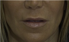 Dermal Fillers Before Photo by Ricardo Rodriguez, MD; Lutherville-Timonium, MD - Case 27033