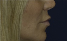 Dermal Fillers Before Photo by Ricardo Rodriguez, MD; Lutherville-Timonium, MD - Case 27033