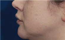 Dermal Fillers Before Photo by Ricardo Rodriguez, MD; Lutherville-Timonium, MD - Case 27034