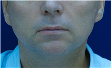 Dermal Fillers Before Photo by Ricardo Rodriguez, MD; Lutherville-Timonium, MD - Case 27035