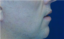 Dermal Fillers After Photo by Ricardo Rodriguez, MD; Lutherville-Timonium, MD - Case 27035