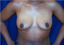 Breast Lift Before Photo by Ricardo Rodriguez, MD; Lutherville-Timonium, MD - Case 27071