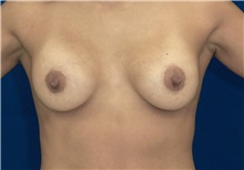 Breast Lift After Photo by Ricardo Rodriguez, MD; Lutherville-Timonium, MD - Case 27072