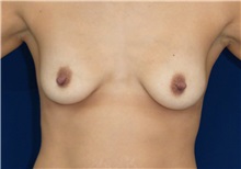 Breast Lift Before Photo by Ricardo Rodriguez, MD; Lutherville-Timonium, MD - Case 27072