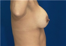 Breast Lift After Photo by Ricardo Rodriguez, MD; Lutherville-Timonium, MD - Case 27072