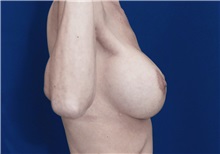 Breast Lift After Photo by Ricardo Rodriguez, MD; Lutherville-Timonium, MD - Case 27073