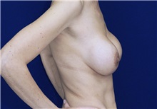 Breast Lift Before Photo by Ricardo Rodriguez, MD; Lutherville-Timonium, MD - Case 27073