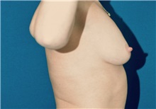 Breast Lift Before Photo by Ricardo Rodriguez, MD; Lutherville-Timonium, MD - Case 27076