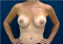 Breast Lift After Photo by Ricardo Rodriguez, MD; Lutherville-Timonium, MD - Case 27079
