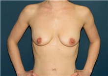 Breast Lift Before Photo by Ricardo Rodriguez, MD; Lutherville-Timonium, MD - Case 27079