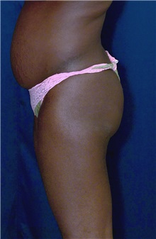 Buttock Implants Before Photo by Ricardo Rodriguez, MD; Lutherville-Timonium, MD - Case 27087