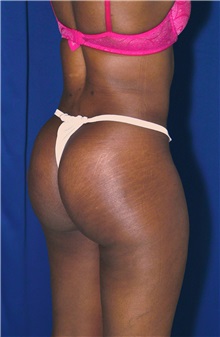 Buttock Implants After Photo by Ricardo Rodriguez, MD; Lutherville-Timonium, MD - Case 27088