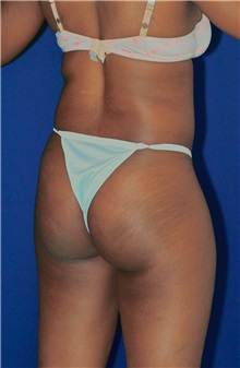 Buttock Implants Before Photo by Ricardo Rodriguez, MD; Lutherville-Timonium, MD - Case 27088