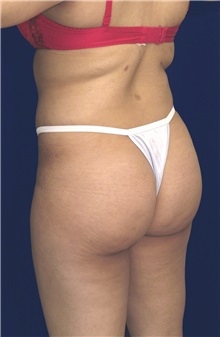Buttock Implants After Photo by Ricardo Rodriguez, MD; Lutherville-Timonium, MD - Case 27089