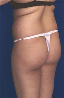 Buttock Implants Before Photo by Ricardo Rodriguez, MD; Lutherville-Timonium, MD - Case 27089