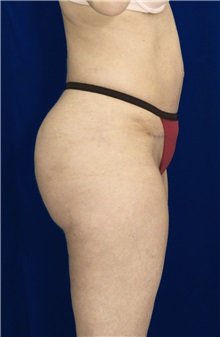 Buttock Implants After Photo by Ricardo Rodriguez, MD; Lutherville-Timonium, MD - Case 27090
