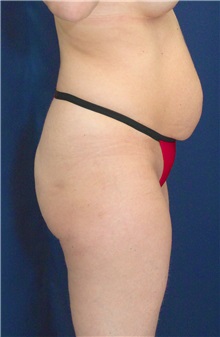 Buttock Implants Before Photo by Ricardo Rodriguez, MD; Lutherville-Timonium, MD - Case 27090