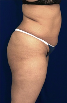 Buttock Implants Before Photo by Ricardo Rodriguez, MD; Lutherville-Timonium, MD - Case 27091