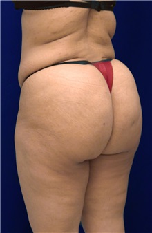 Buttock Implants After Photo by Ricardo Rodriguez, MD; Lutherville-Timonium, MD - Case 27091