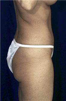 Tummy Tuck After Photo by Ricardo Rodriguez, MD; Lutherville-Timonium, MD - Case 27092