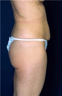 Tummy Tuck Before Photo by Ricardo Rodriguez, MD; Lutherville-Timonium, MD - Case 27092