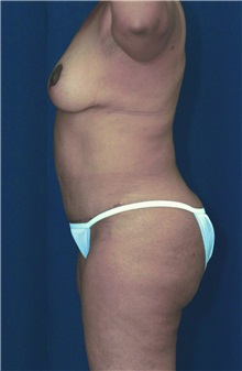 Tummy Tuck After Photo by Ricardo Rodriguez, MD; Lutherville-Timonium, MD - Case 27095