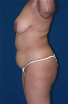 Tummy Tuck Before Photo by Ricardo Rodriguez, MD; Lutherville-Timonium, MD - Case 27095