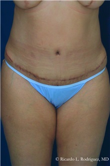 Tummy Tuck After Photo by Ricardo Rodriguez, MD; Lutherville-Timonium, MD - Case 27095