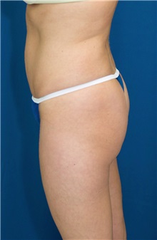 Tummy Tuck After Photo by Ricardo Rodriguez, MD; Lutherville-Timonium, MD - Case 27101