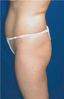 Tummy Tuck Before Photo by Ricardo Rodriguez, MD; Lutherville-Timonium, MD - Case 27101