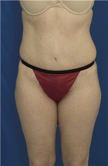 Tummy Tuck After Photo by Ricardo Rodriguez, MD; Lutherville-Timonium, MD - Case 27102