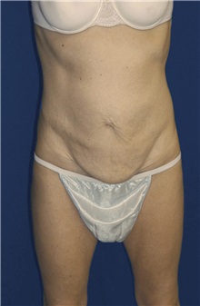 Tummy Tuck Before Photo by Ricardo Rodriguez, MD; Lutherville-Timonium, MD - Case 27102