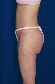 Tummy Tuck After Photo by Ricardo Rodriguez, MD; Lutherville-Timonium, MD - Case 27103