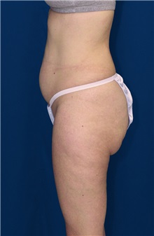 Tummy Tuck Before Photo by Ricardo Rodriguez, MD; Lutherville-Timonium, MD - Case 27103